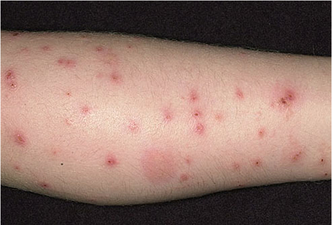 parasite bites